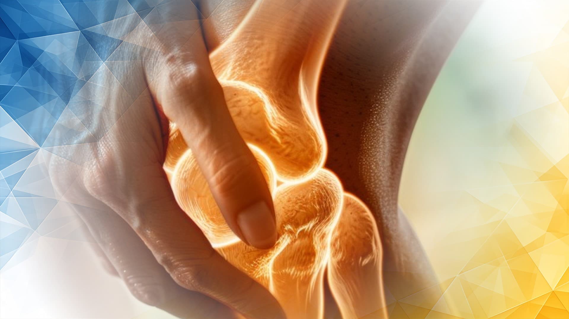 Arthrosamid Treatment for Patellofemoral Osteoarthritis Kneecap Pain Relief