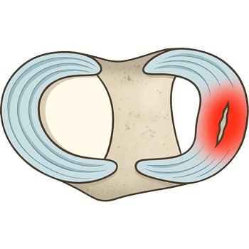 Meniscus