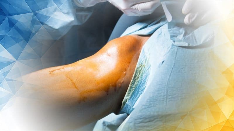 Bone Cement Benefits in Knee Replacement Surgery in the UK