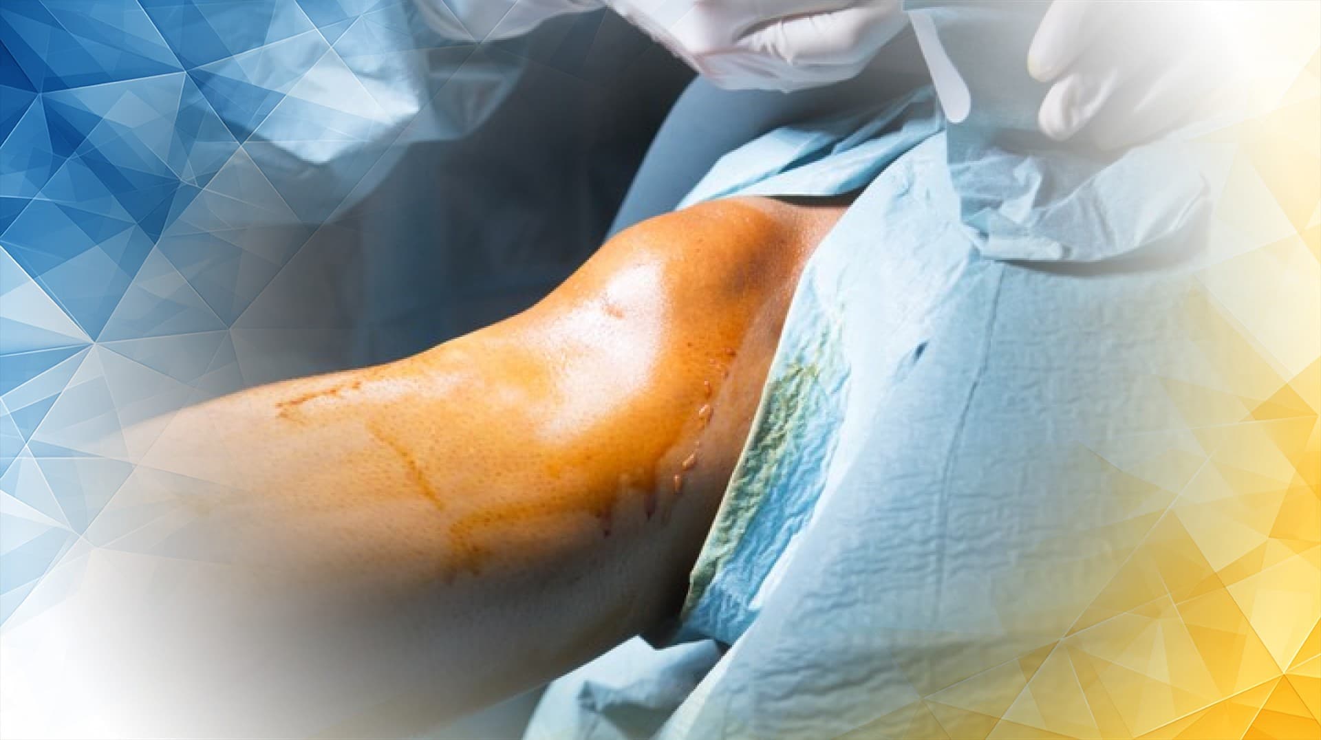 Bone Cement Benefits in Knee Replacement Surgery in the UK